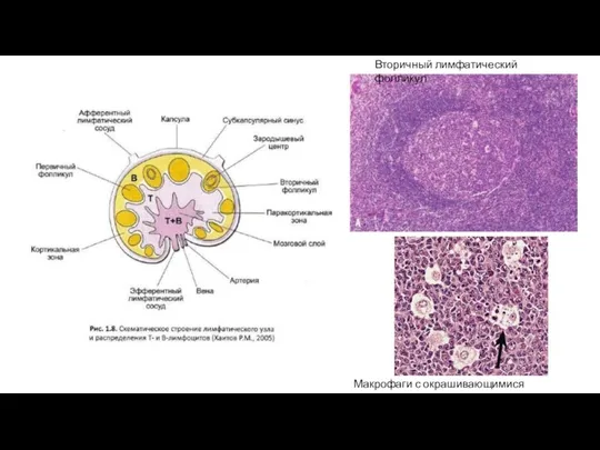 Вторичный лимфатический фолликул Макрофаги с окрашивающимися включениями