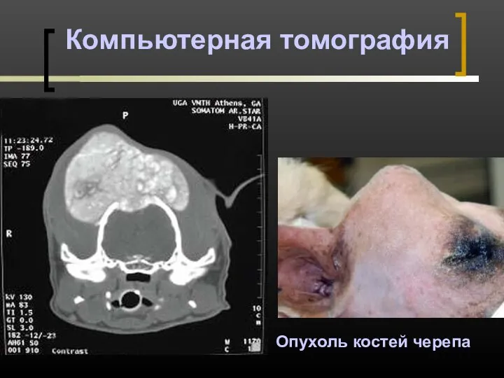 Компьютерная томография Опухоль костей черепа