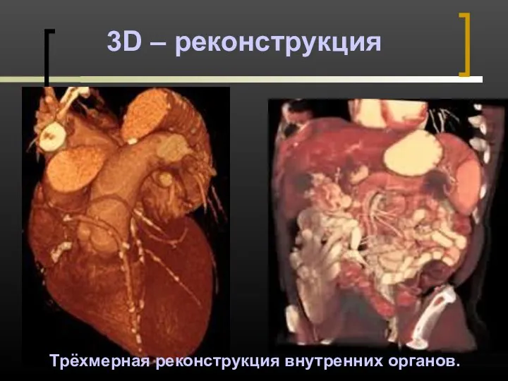 3D – реконструкция Трёхмерная реконструкция внутренних органов.