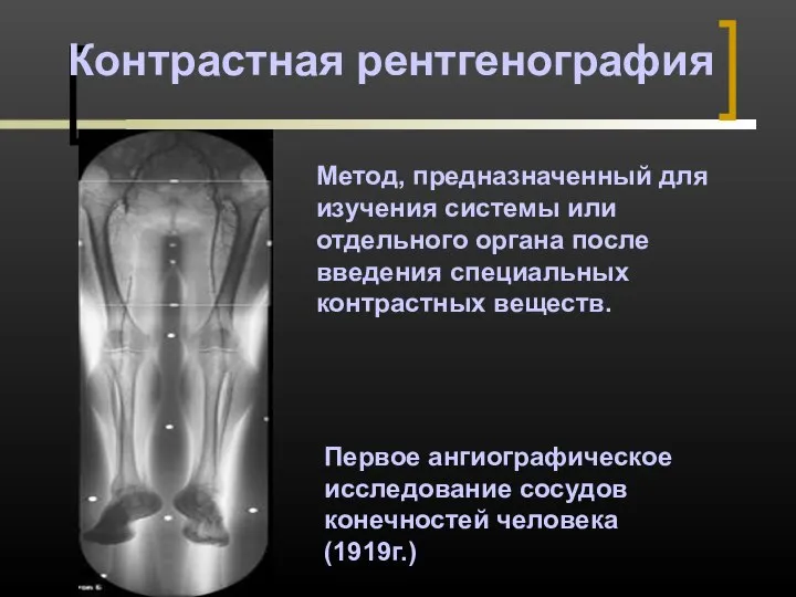 Контрастная рентгенография Первое ангиографическое исследование сосудов конечностей человека (1919г.) Метод, предназначенный для