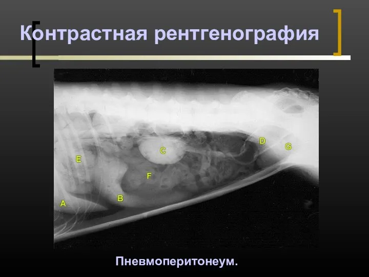 Контрастная рентгенография Пневмоперитонеум.