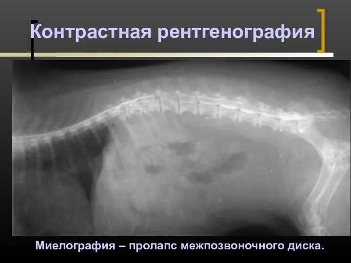 Контрастная рентгенография Миелография – пролапс межпозвоночного диска.