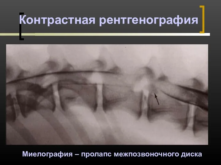 Контрастная рентгенография Миелография – пролапс межпозвоночного диска