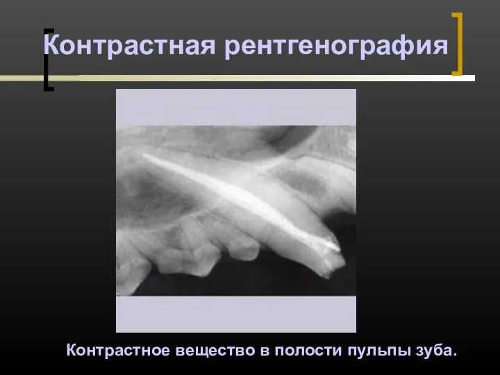 Контрастная рентгенография Контрастное вещество в полости пульпы зуба.