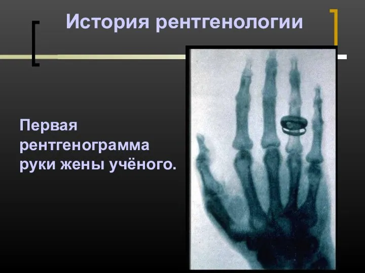 История рентгенологии Первая рентгенограмма руки жены учёного.