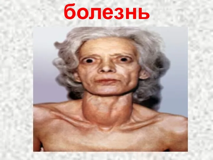 Базедова болезнь