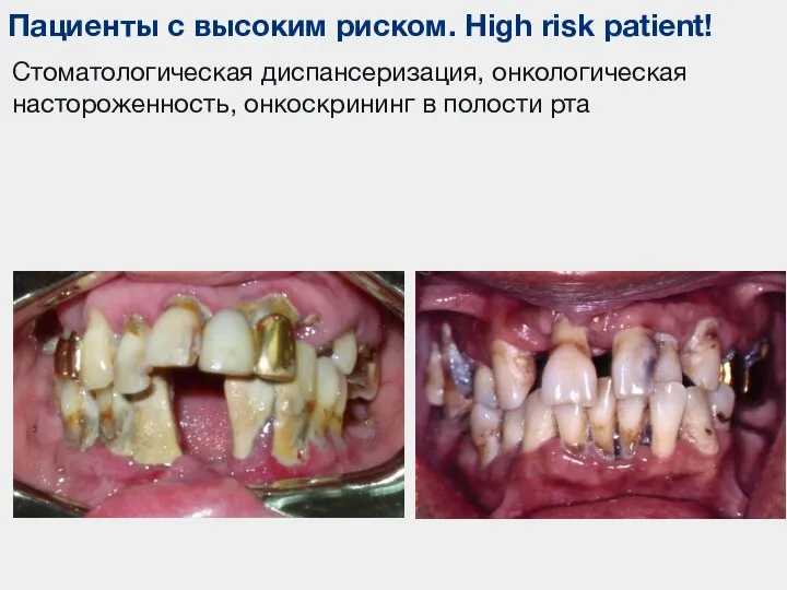 Пациенты с высоким риском. High risk patient! Стоматологическая диспансеризация, онкологическая настороженность, онкоскрининг в полости рта