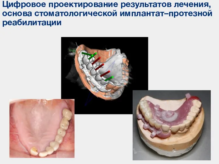 Цифровое проектирование результатов лечения, основа стоматологической имплантат–протезной реабилитации
