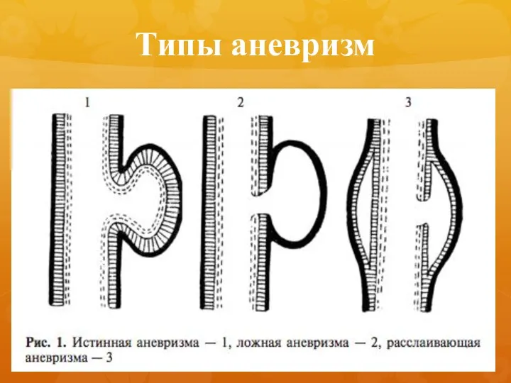 Типы аневризм