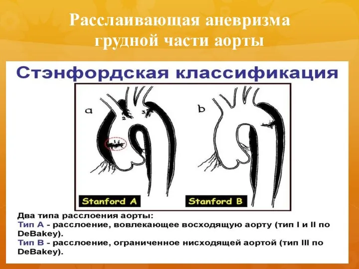 Расслаивающая аневризма грудной части аорты