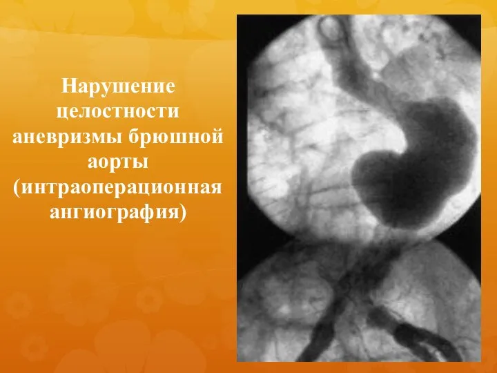 Нарушение целостности аневризмы брюшной аорты (интраоперационная ангиография)