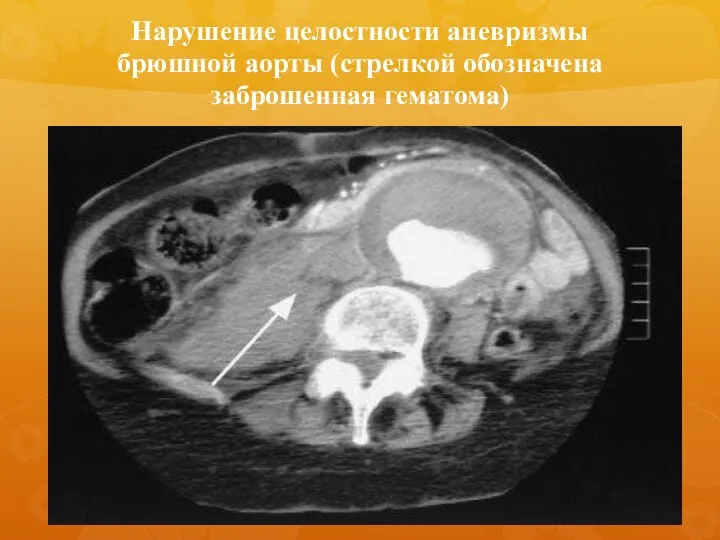 Нарушение целостности аневризмы брюшной аорты (стрелкой обозначена заброшенная гематома)