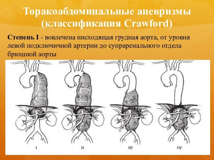 Торакоабдоминальные аневризмы (классификация Crawford) Степень I - вовлечена нисходящая грудная аорта, от