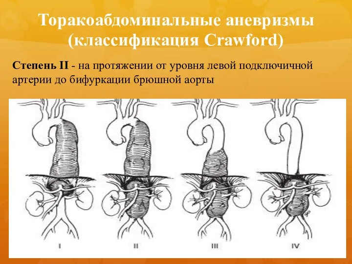 Степень II - на протяжении от уровня левой подключичной артерии до бифуркации