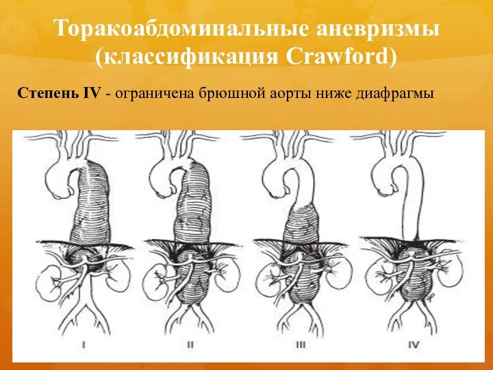 Степень IV - ограничена брюшной аорты ниже диафрагмы Торакоабдоминальные аневризмы (классификация Crawford)