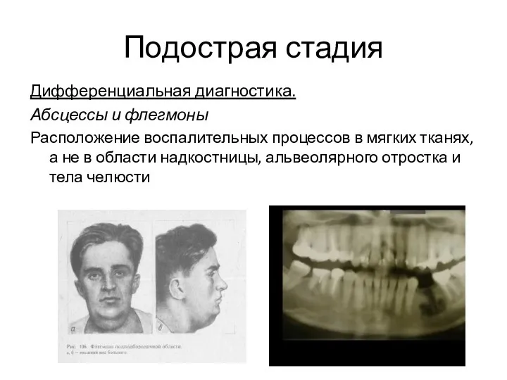 Подострая стадия Дифференциальная диагностика. Абсцессы и флегмоны Расположение воспалительных процессов в мягких