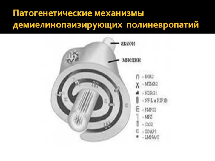 Патогенетические механизмы демиелинопаизирующих полиневропатий