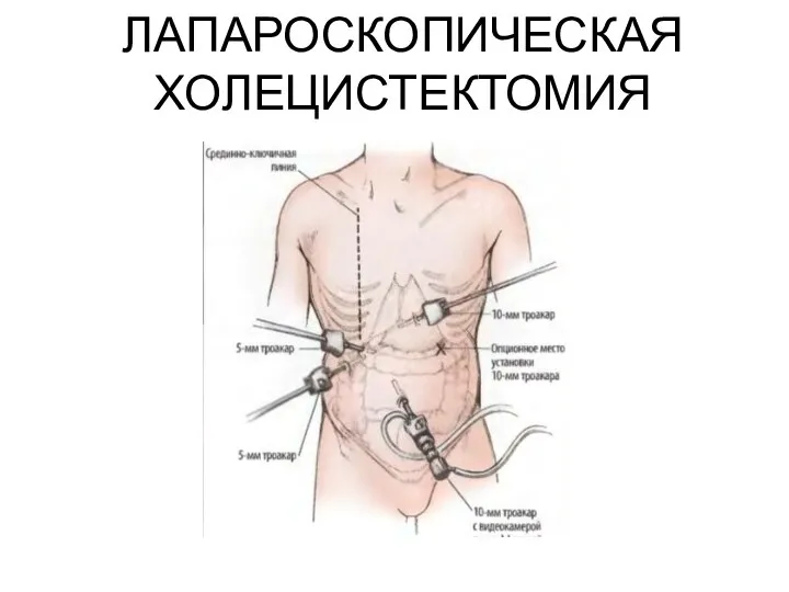 ЛАПАРОСКОПИЧЕСКАЯ ХОЛЕЦИСТЕКТОМИЯ