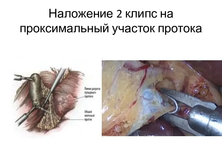 Наложение 2 клипс на проксимальный участок протока