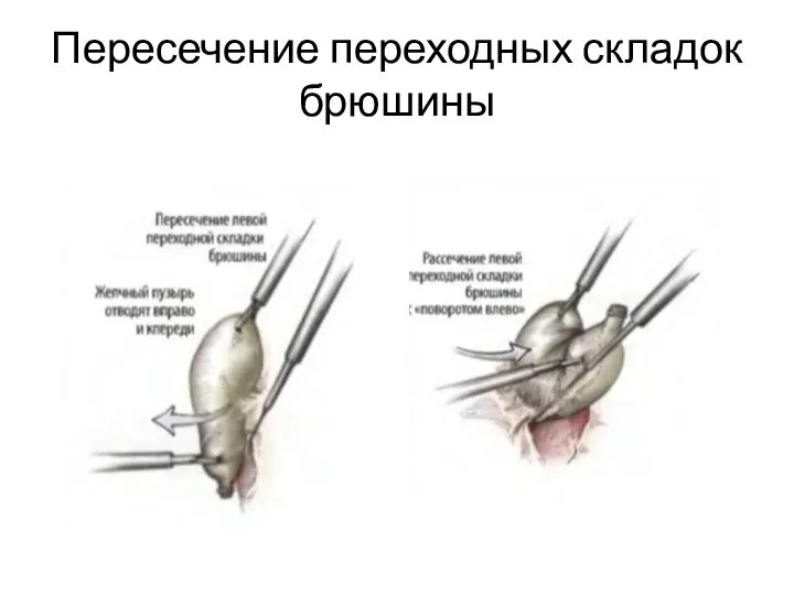 Пересечение переходных складок брюшины