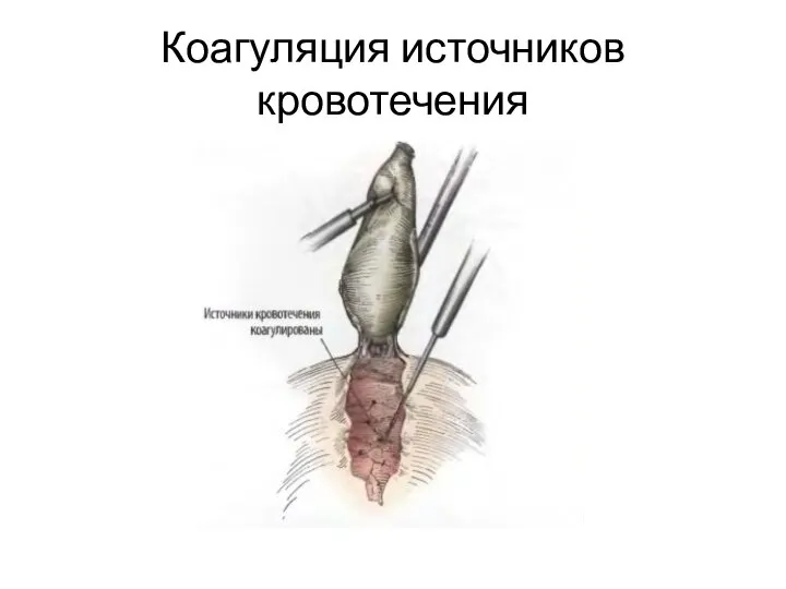 Коагуляция источников кровотечения