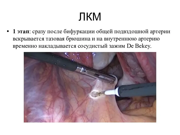 ЛКМ 1 этап: сразу после бифуркации общей подвздошной артерии вскрывается тазовая брюшина
