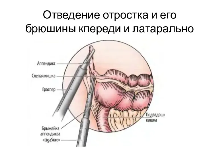 Отведение отростка и его брюшины кпереди и латарально