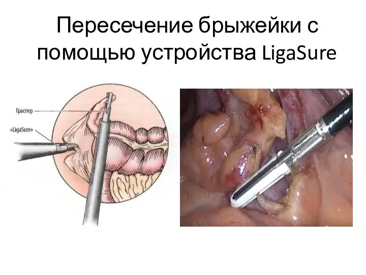 Пересечение брыжейки с помощью устройства LigaSure