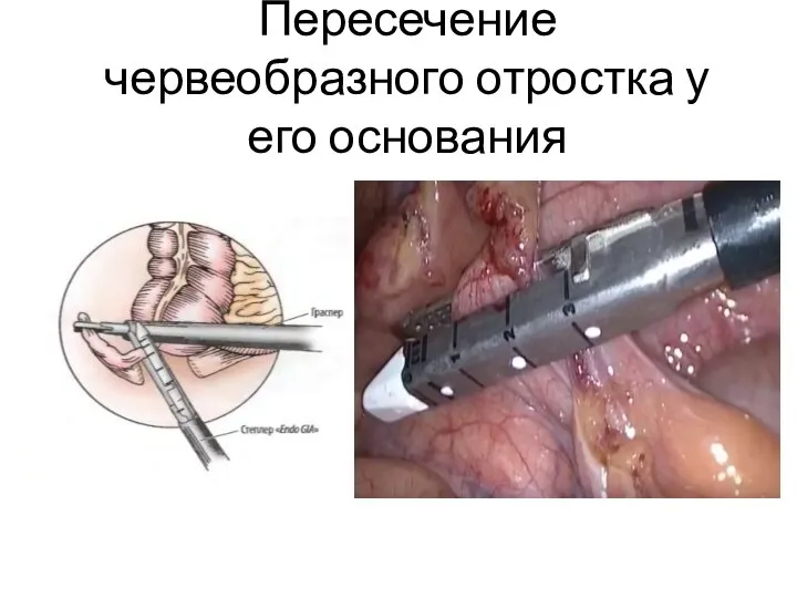 Пересечение червеобразного отростка у его основания