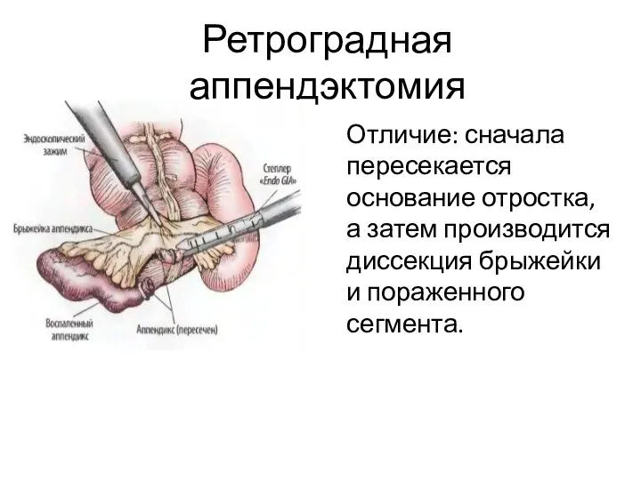 Ретроградная аппендэктомия Отличие: сначала пересекается основание отростка, а затем производится диссекция брыжейки и пораженного сегмента.