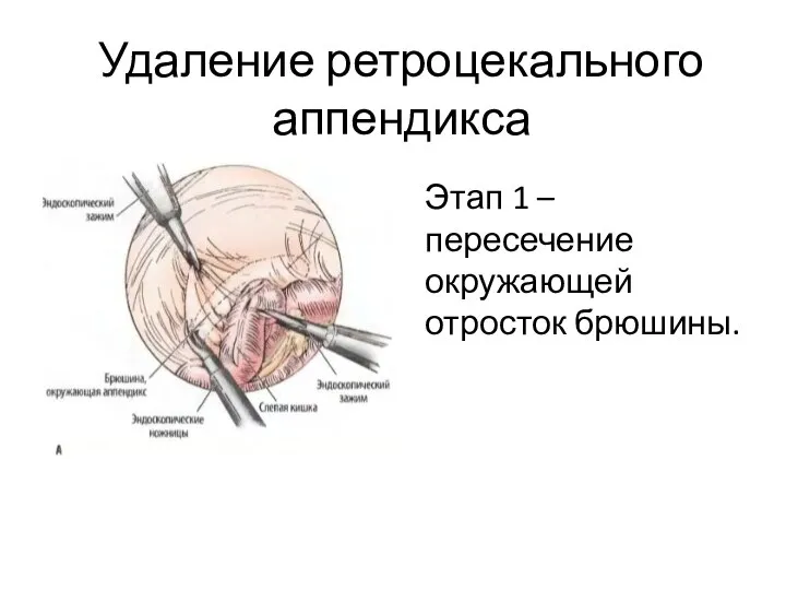 Удаление ретроцекального аппендикса Этап 1 – пересечение окружающей отросток брюшины.