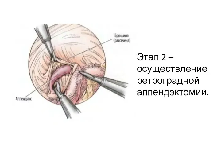 Этап 2 – осуществление ретроградной аппендэктомии.