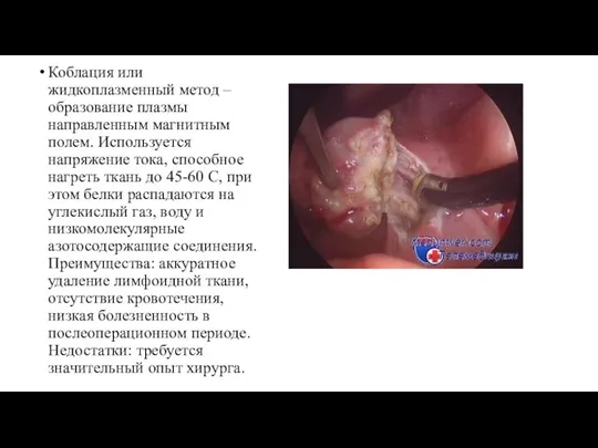 Коблация или жидкоплазменный метод – образование плазмы направленным магнитным полем. Используется напряжение