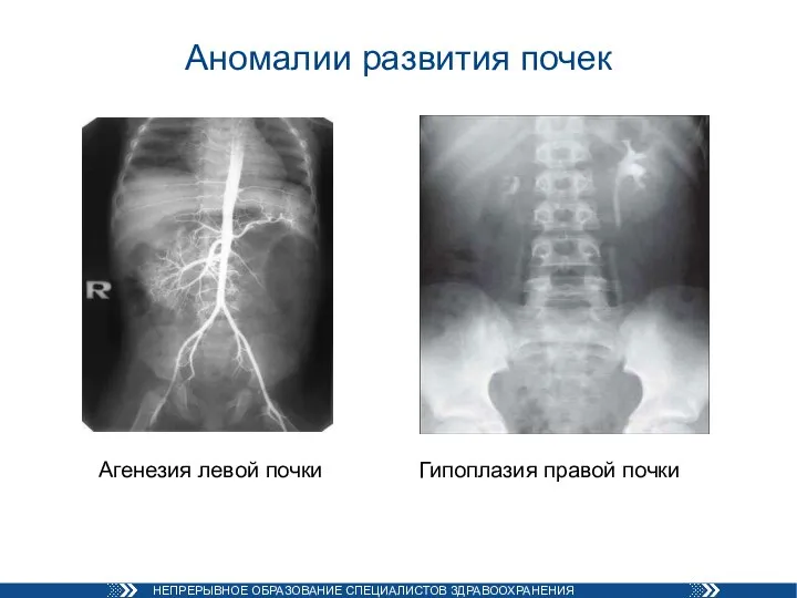 Аномалии развития почек Агенезия левой почки Гипоплазия правой почки