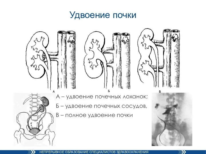 Удвоение почки А – удвоение почечных лоханок; Б – удвоение почечных сосудов,