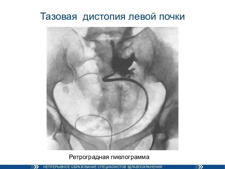 Тазовая дистопия левой почки Ретроградная пиелограмма