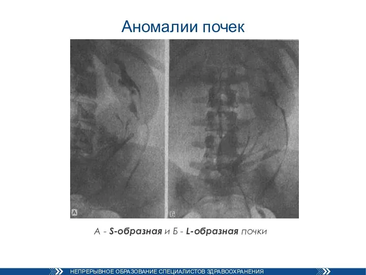 Аномалии почек А - S-образная и Б - L-образная почки