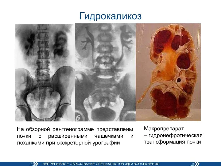 Гидрокаликоз На обзорной рентгенограмме представлены почки с расширенными чашечками и лоханками при