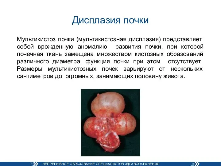 Дисплазия почки Мультикистоз почки (мультикистозная дисплазия) представляет собой врожденную аномалию развития почки,