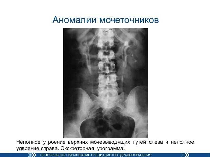 Аномалии мочеточников Неполное утроение верхних мочевыводящих путей слева и неполное удвоение справа. Экскреторная урограмма.