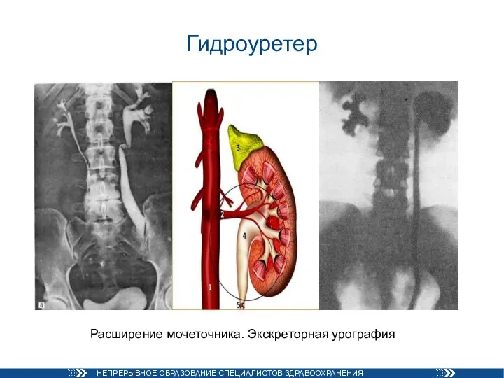 Гидроуретер Расширение мочеточника. Экскреторная урография