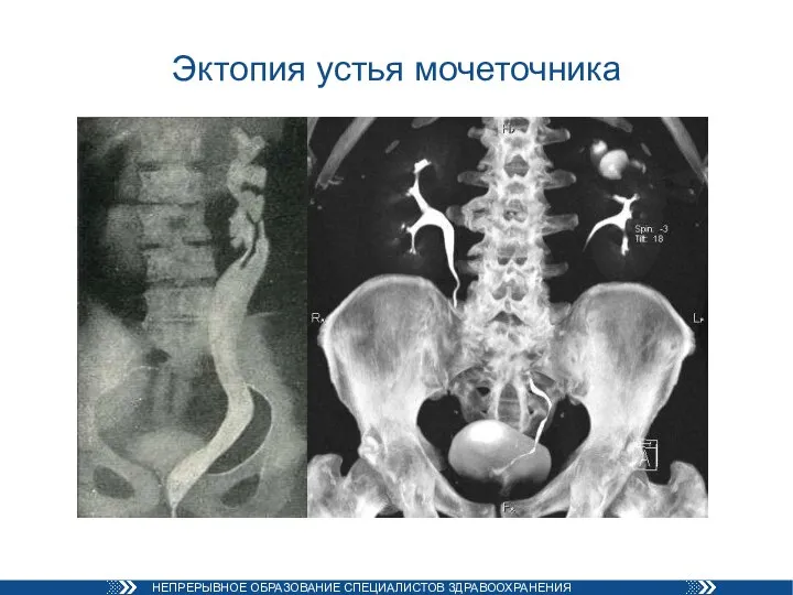 Эктопия устья мочеточника