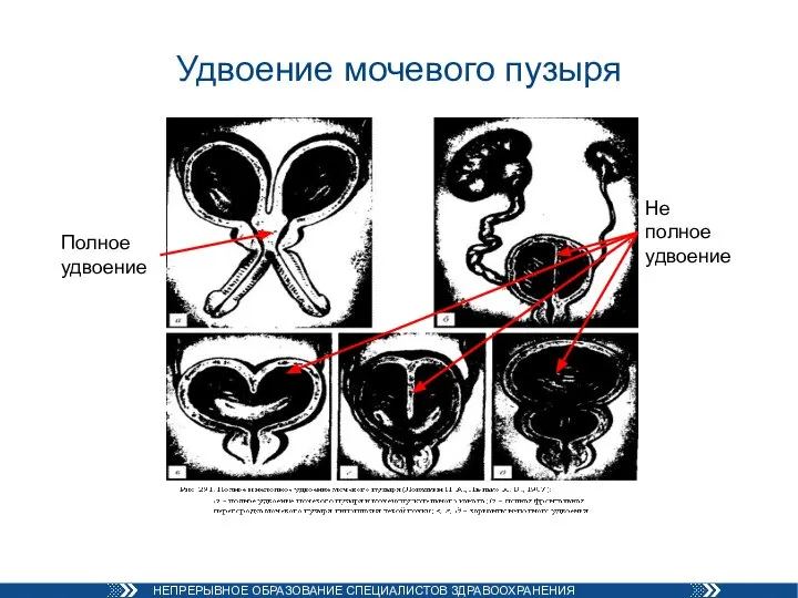 Удвоение мочевого пузыря Полное удвоение Не полное удвоение