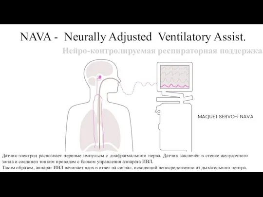 NAVA - Neurally Adjusted Ventilatory Assist. Нейро-контролируемая респираторная поддержка. Датчик-электрод распознает нервные