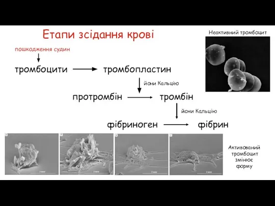 Етапи зсідання крові тромбоцити пошкодження судин тромбопластин йони Кальцію протромбін тромбін фібриноген