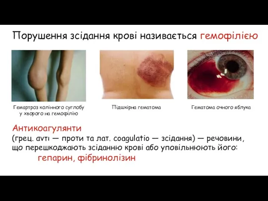 Порушення зсідання крові називається гемофілією Гемартроз колінного суглобу у хворого на гемофілію