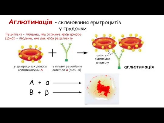 Аглютинація – склеювання еритроцитів у грудочки у еритроцитах донора аглютиногени А у