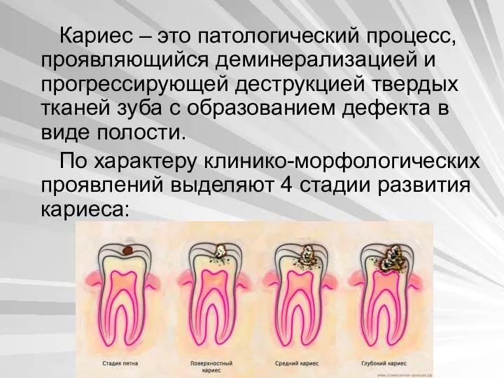 Кариес – это патологический процесс, проявляющийся деминерализацией и прогрессирующей деструкцией твердых тканей