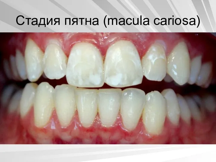 Стадия пятна (macula cariosa)