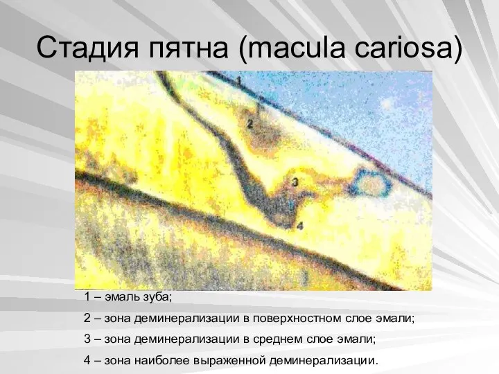 Стадия пятна (macula cariosa) 1 – эмаль зуба; 2 – зона деминерализации